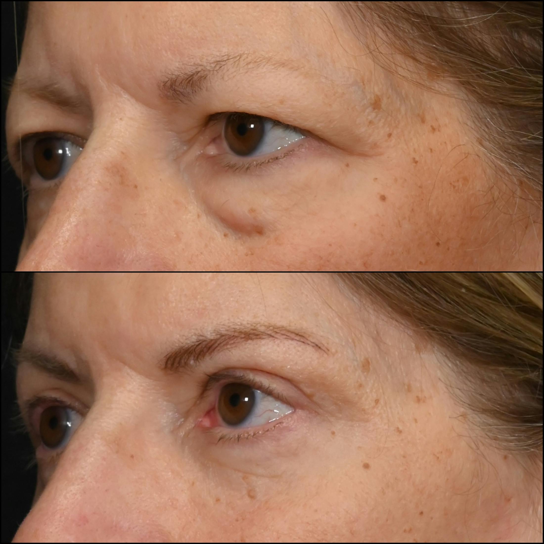 Lower Blepharoplasty Before & After Gallery - Patient 357105 - Image 2