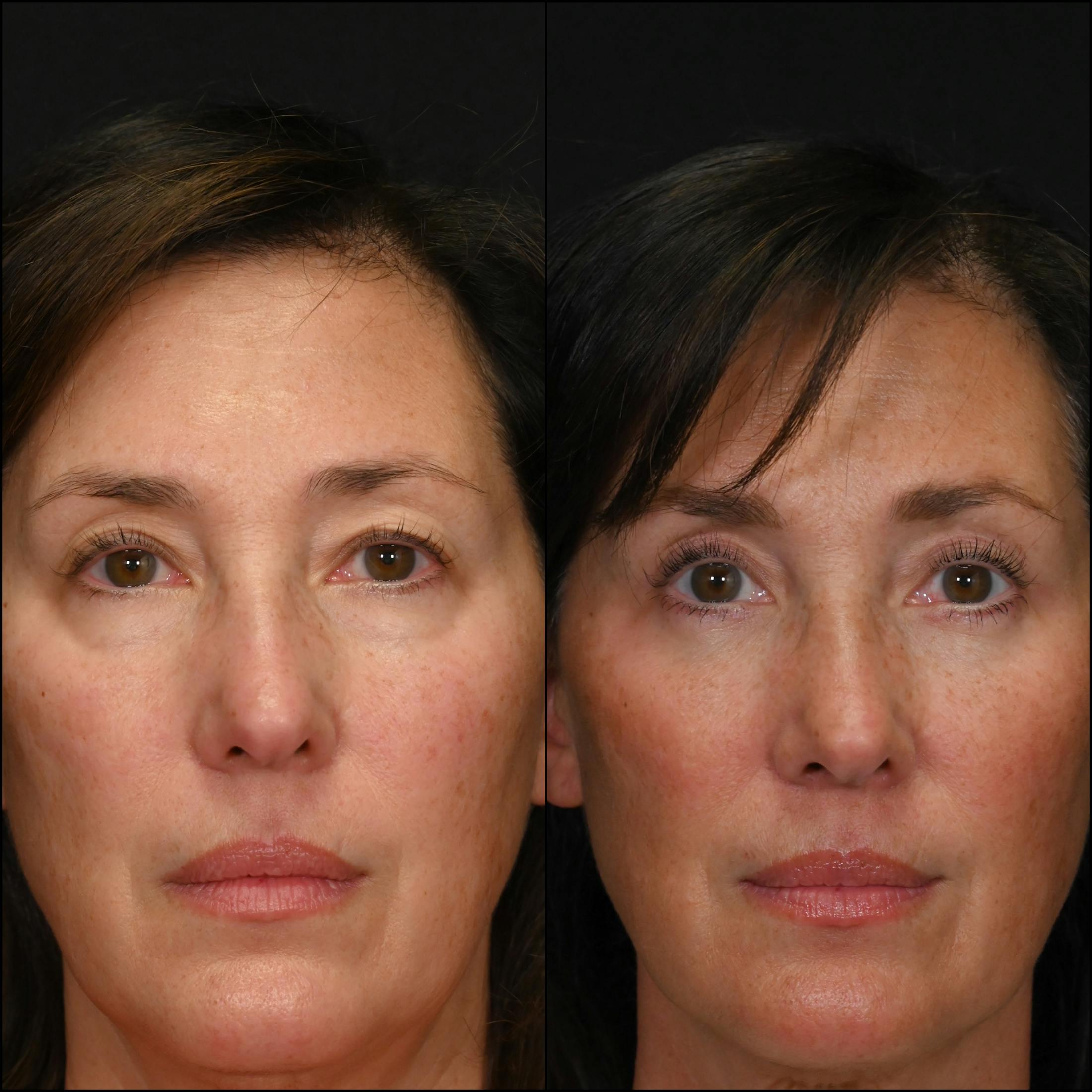 Lower Blepharoplasty Before & After Gallery - Patient 712001 - Image 1
