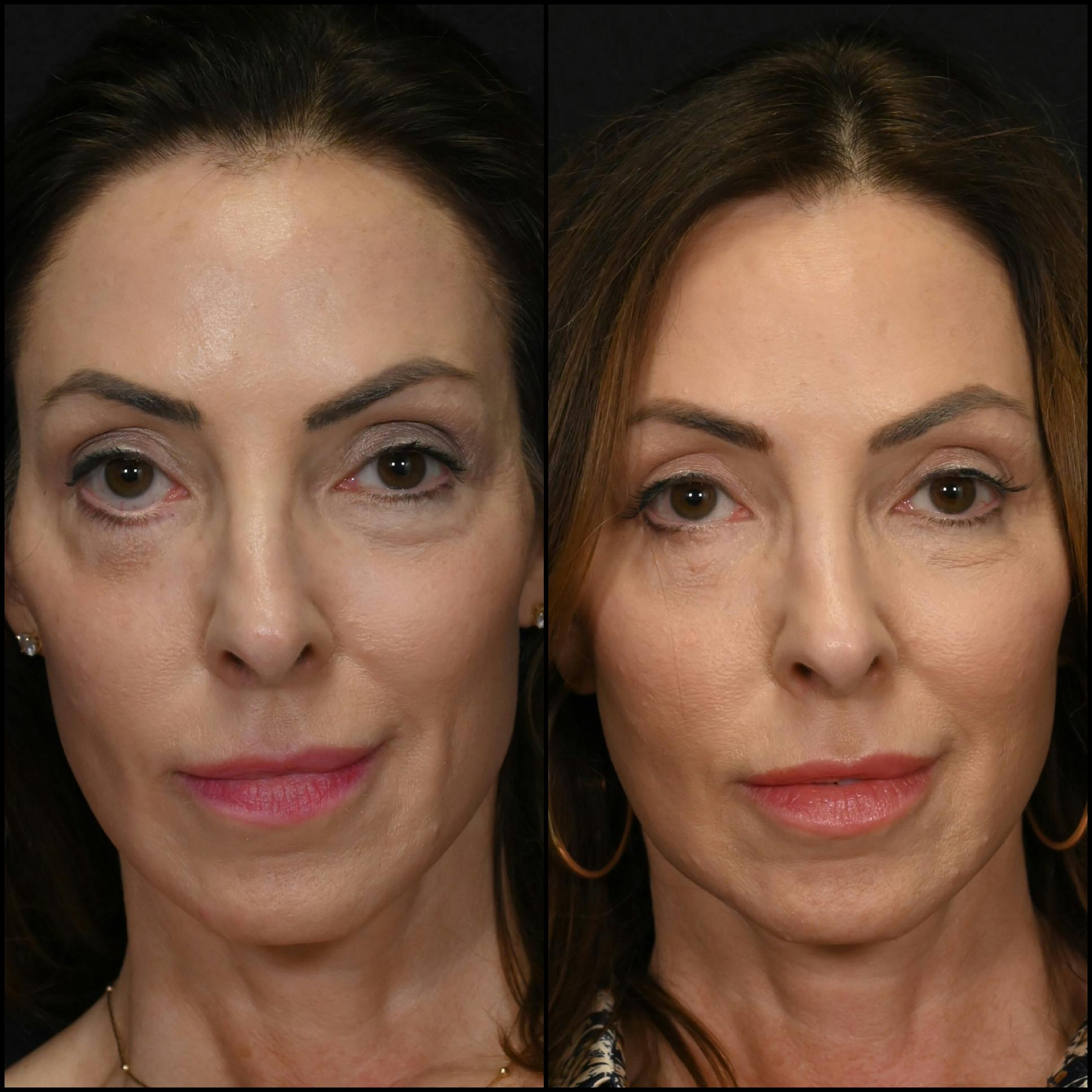 Revision Surgery Before & After Gallery - Patient 953835 - Image 1