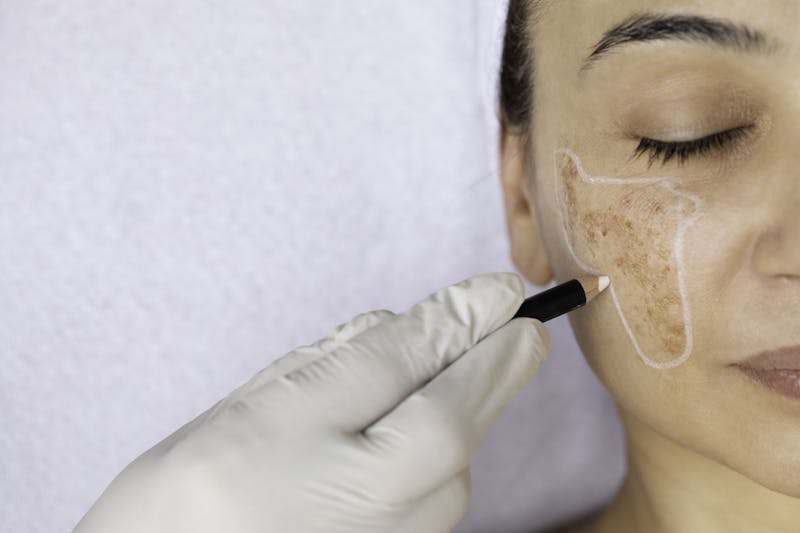 woman with melasma