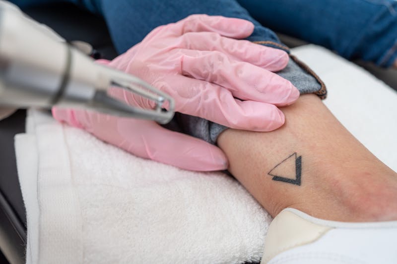 woman getting laser tattoo removal