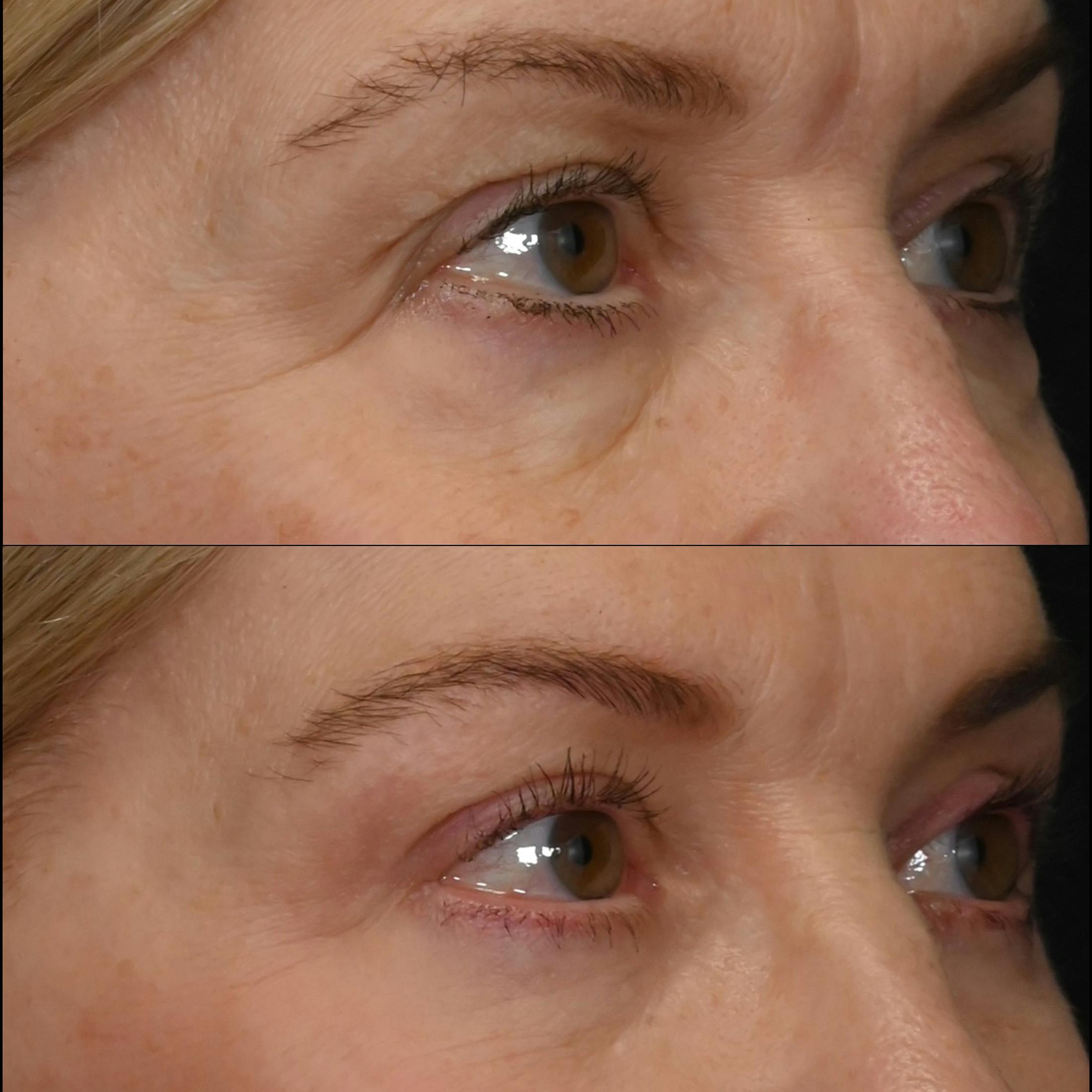 Upper & Lower Blepharoplasty Before & After Gallery - Patient 344973 - Image 1