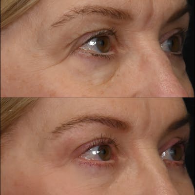 Upper Blepharoplasty Before & After Gallery - Patient 177412 - Image 1