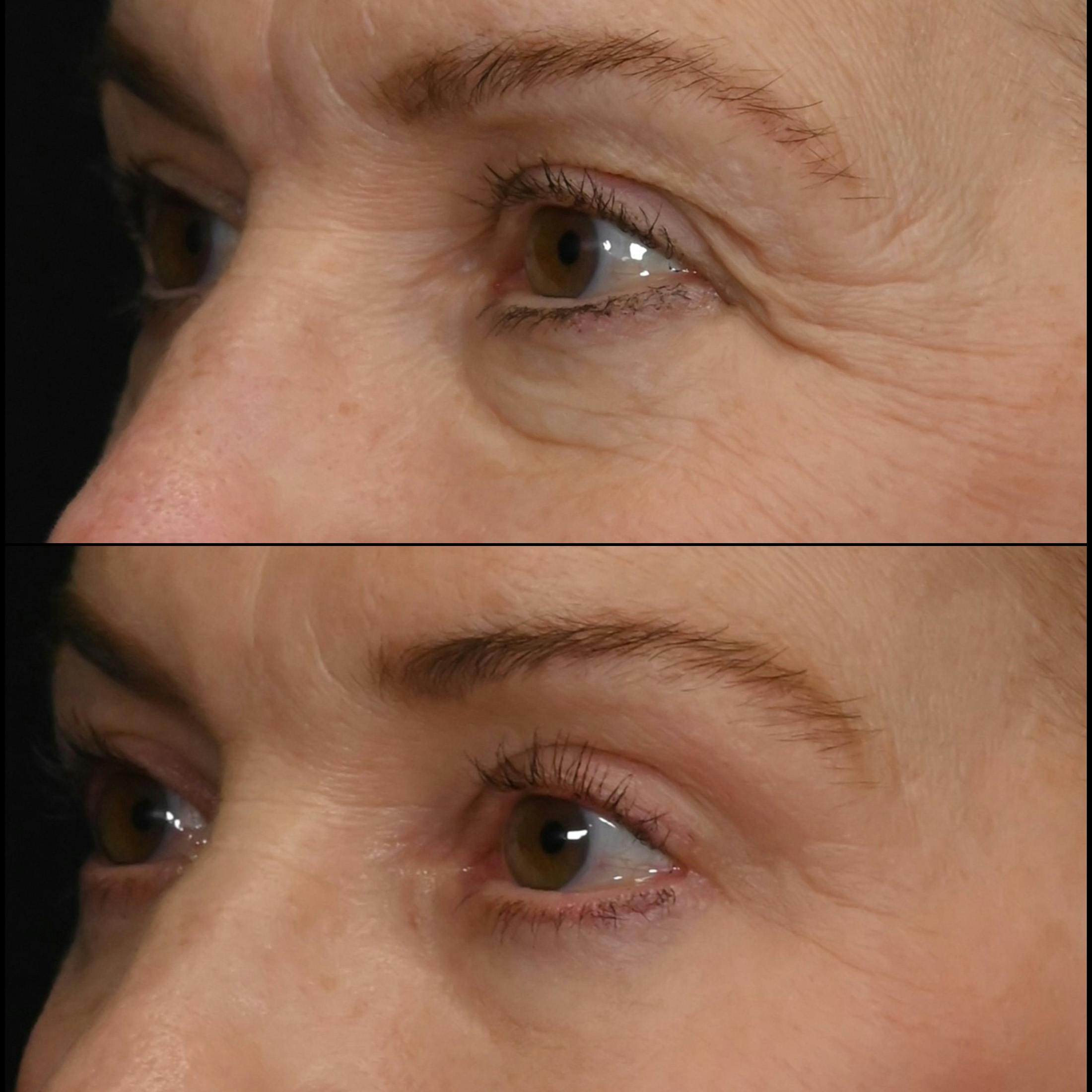 Upper & Lower Blepharoplasty Before & After Gallery - Patient 344973 - Image 2