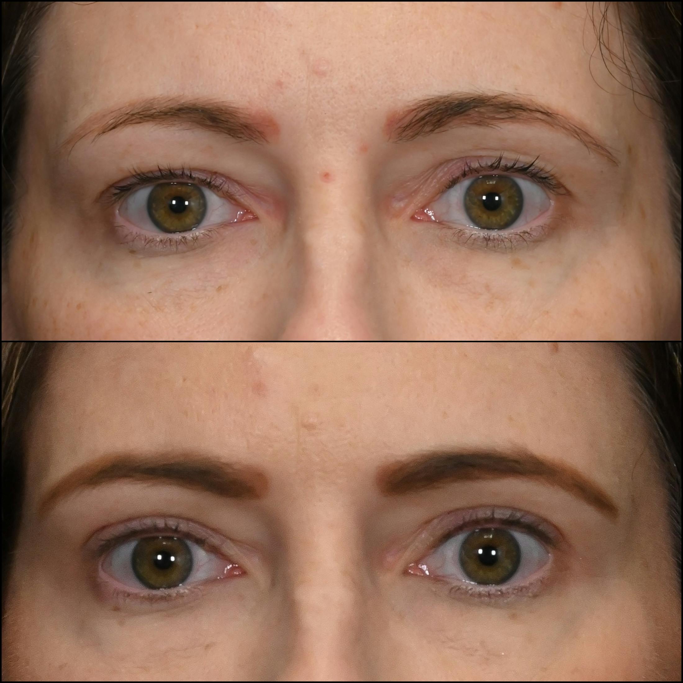 Upper Blepharoplasty Before & After Gallery - Patient 340403 - Image 1