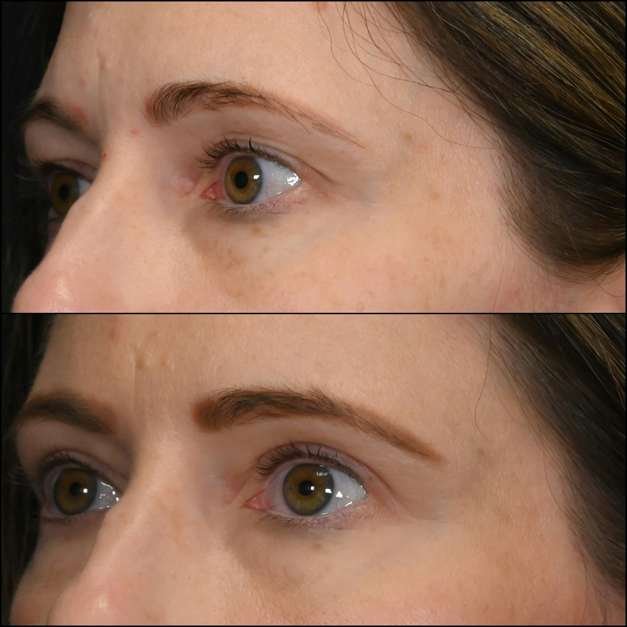 Upper Blepharoplasty Before & After Gallery - Patient 340403 - Image 2