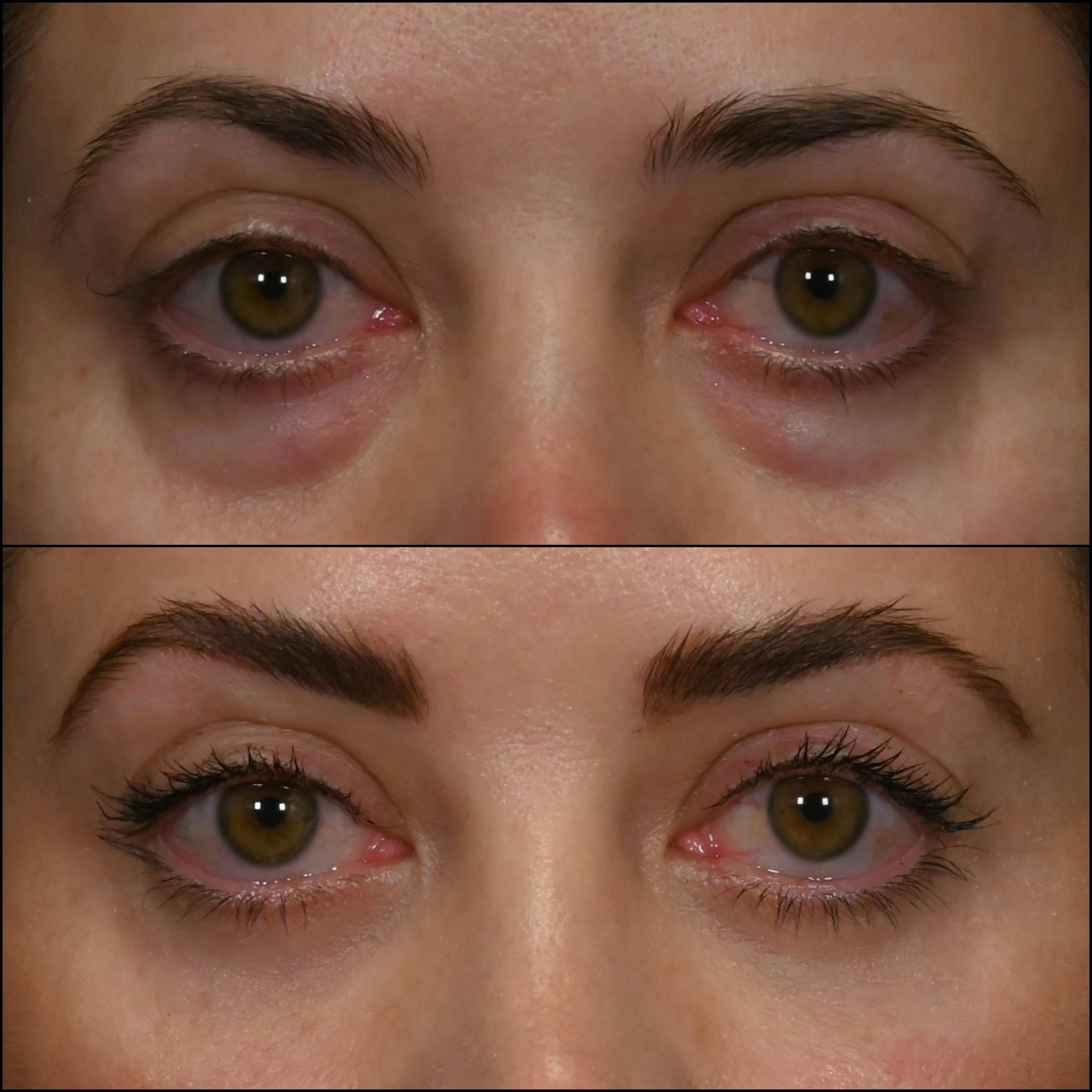 Lower Blepharoplasty Before & After Gallery - Patient 240865 - Image 1