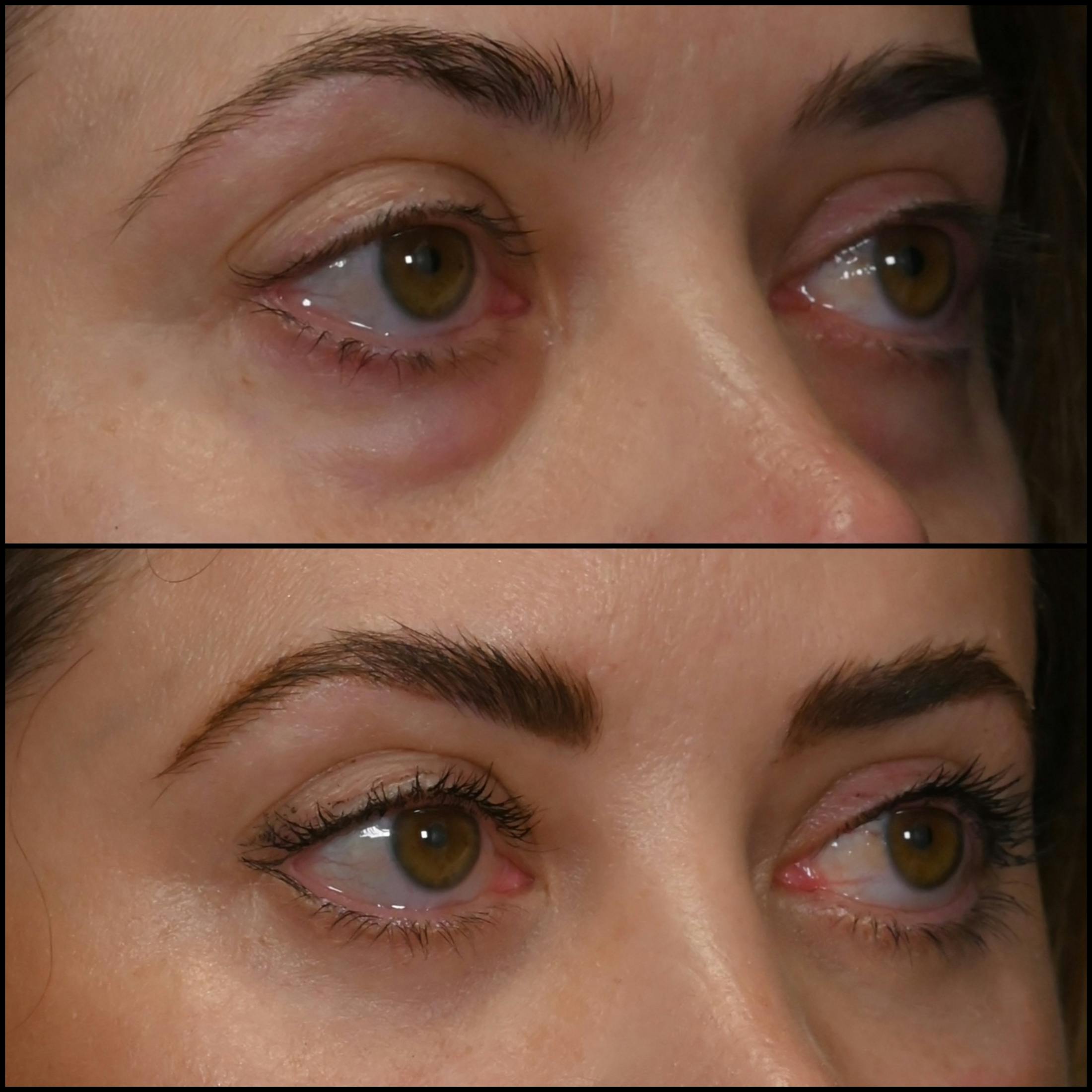Lower Blepharoplasty Before & After Gallery - Patient 240865 - Image 2