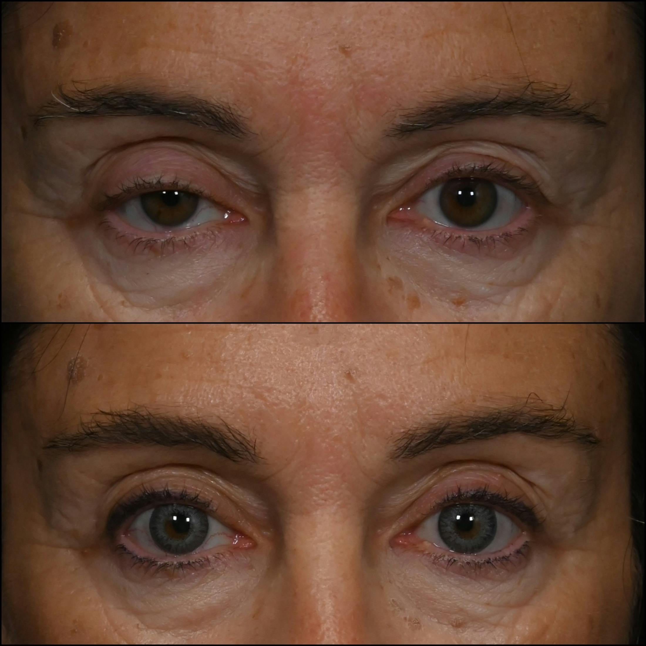 Ptosis Repair Before & After Gallery - Patient 792104 - Image 1