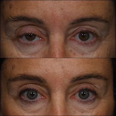 Ptosis Repair Before & After Gallery - Patient 792104 - Image 1