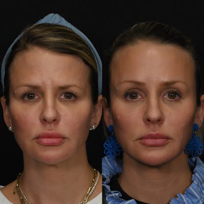Brow Lift Before & After Gallery - Patient 268557 - Image 1