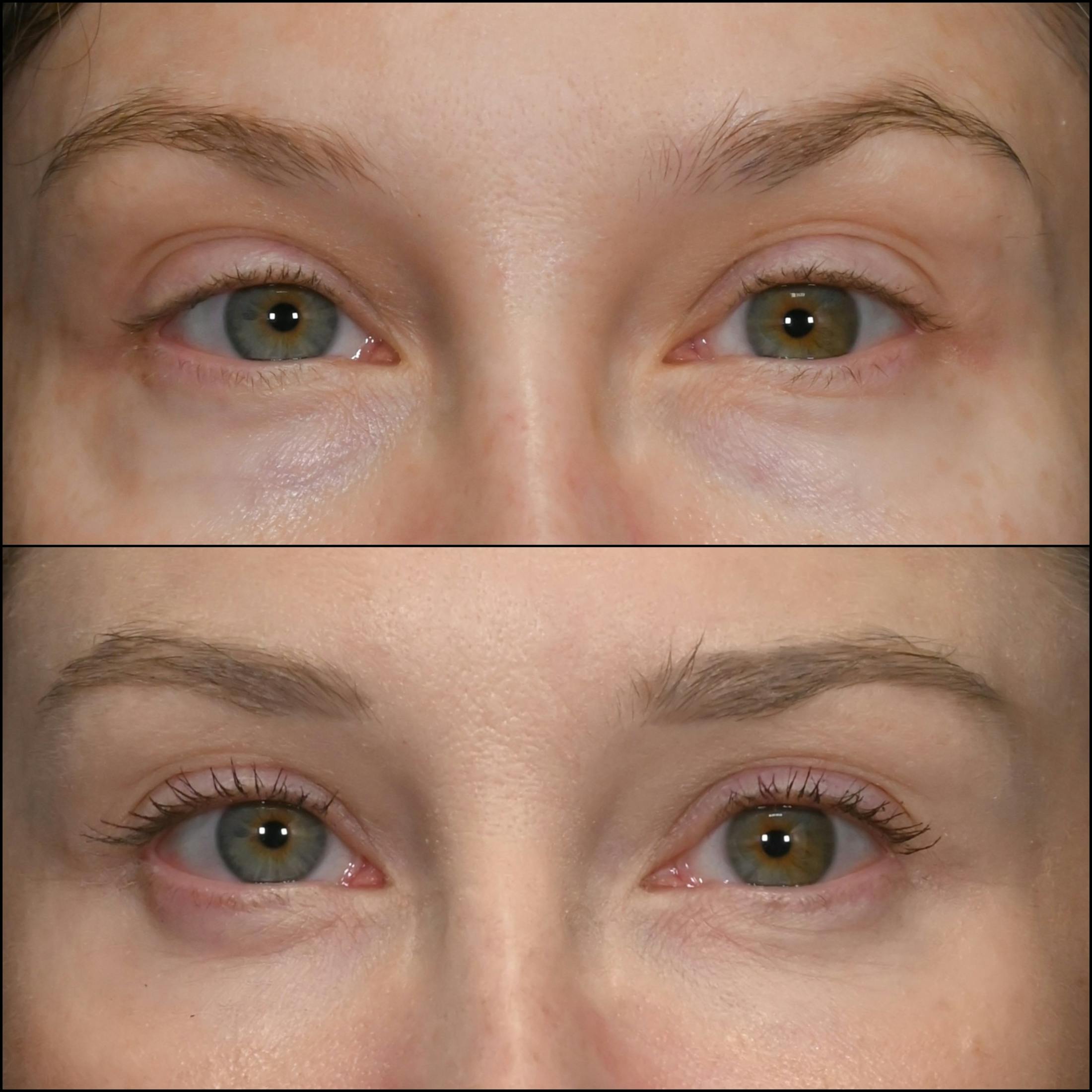 Lower Blepharoplasty Before & After Gallery - Patient 999459 - Image 1