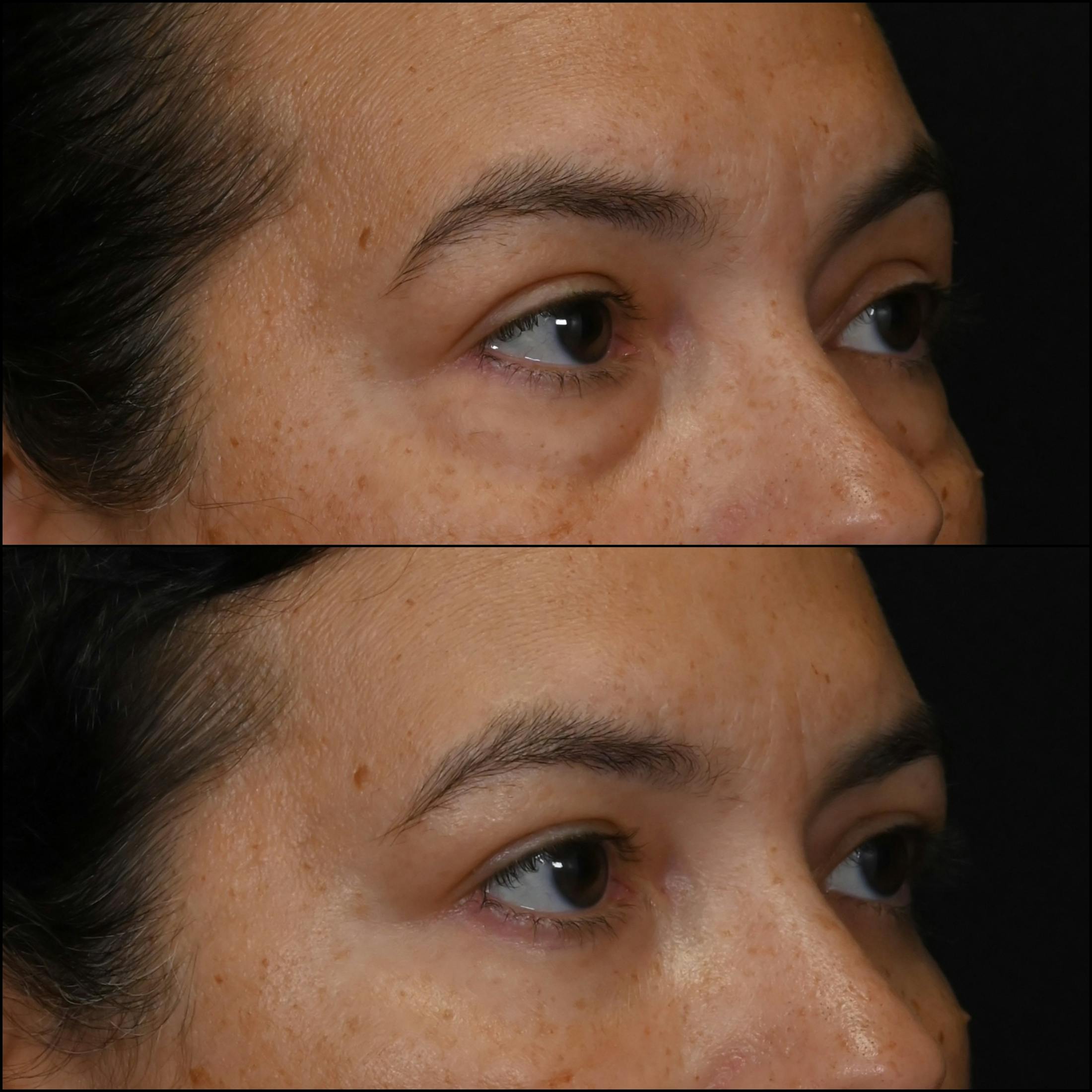 Lower Blepharoplasty Before & After Gallery - Patient 186142 - Image 2