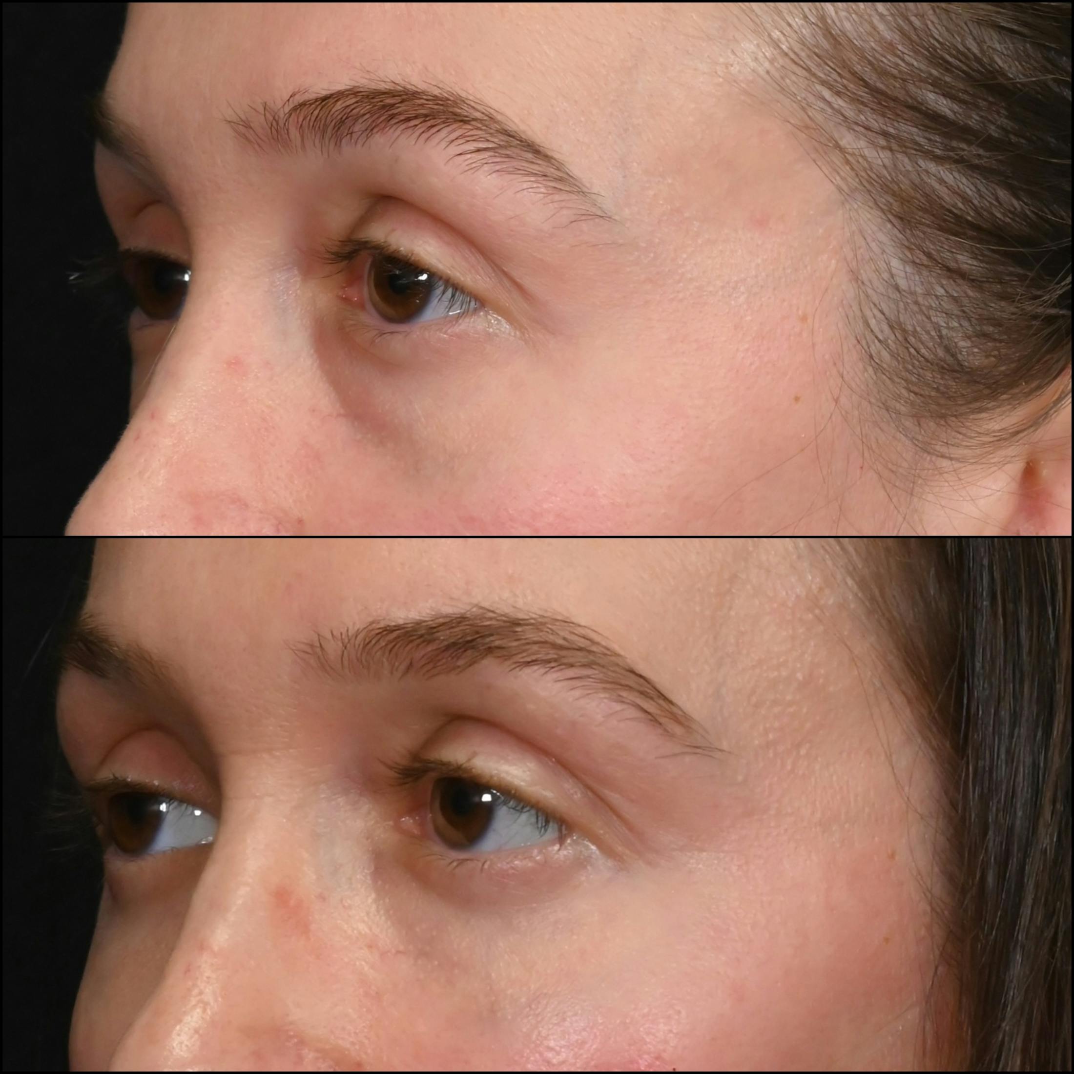 Lower Blepharoplasty Before & After Gallery - Patient 236086 - Image 3