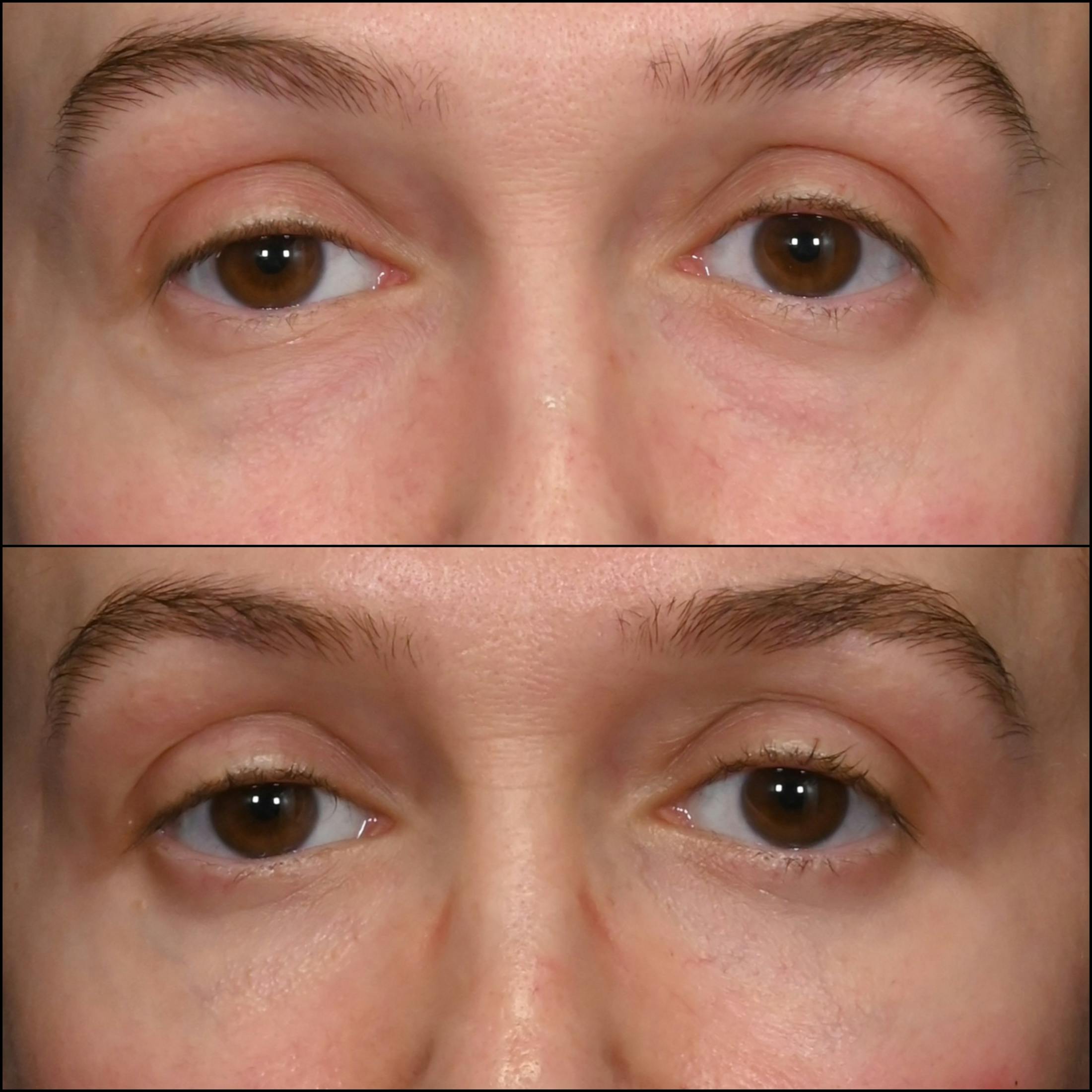 Lower Blepharoplasty Before & After Gallery - Patient 236086 - Image 1