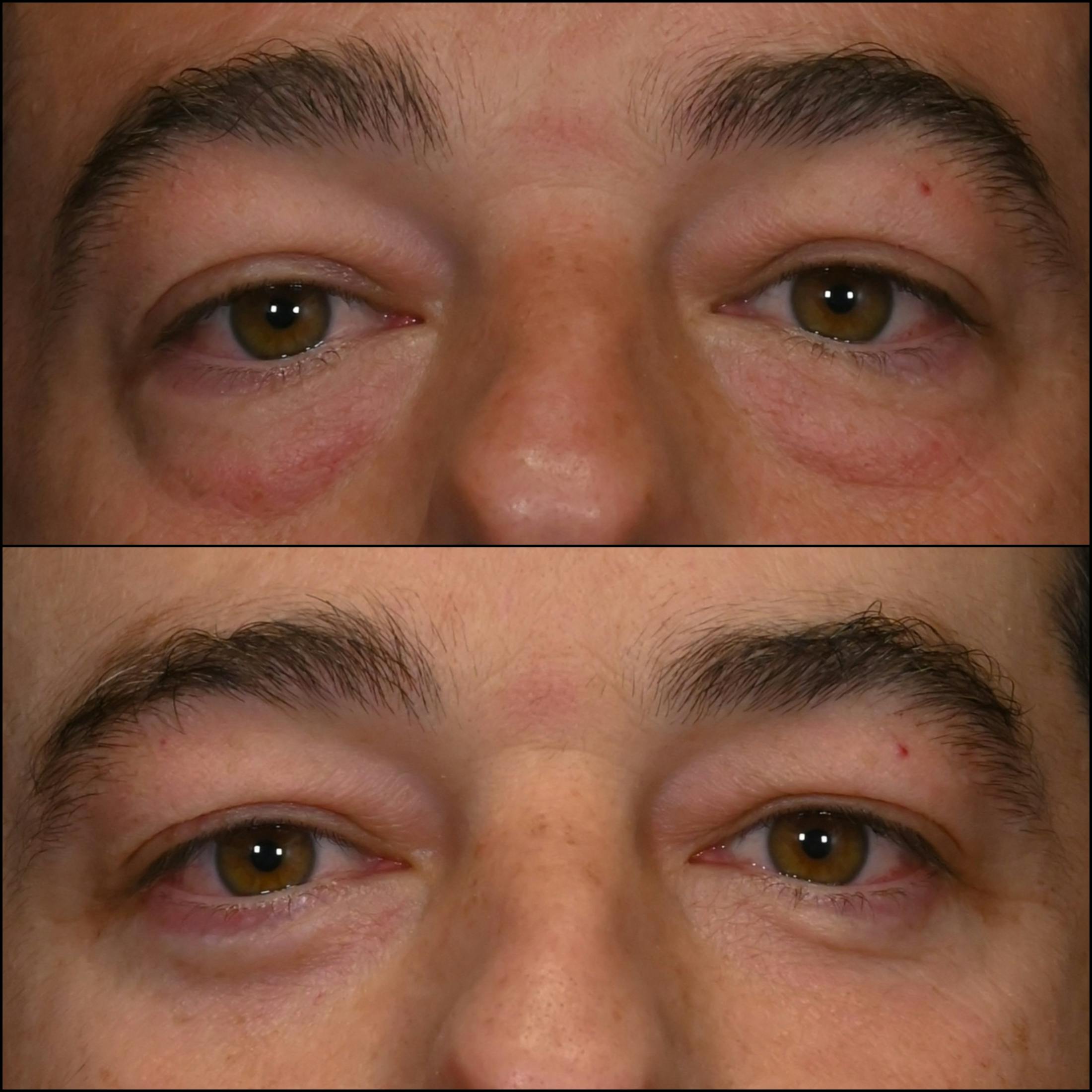 Lower Blepharoplasty Before & After Gallery - Patient 272565 - Image 1