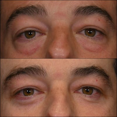 Lower Blepharoplasty Before & After Gallery - Patient 272565 - Image 1