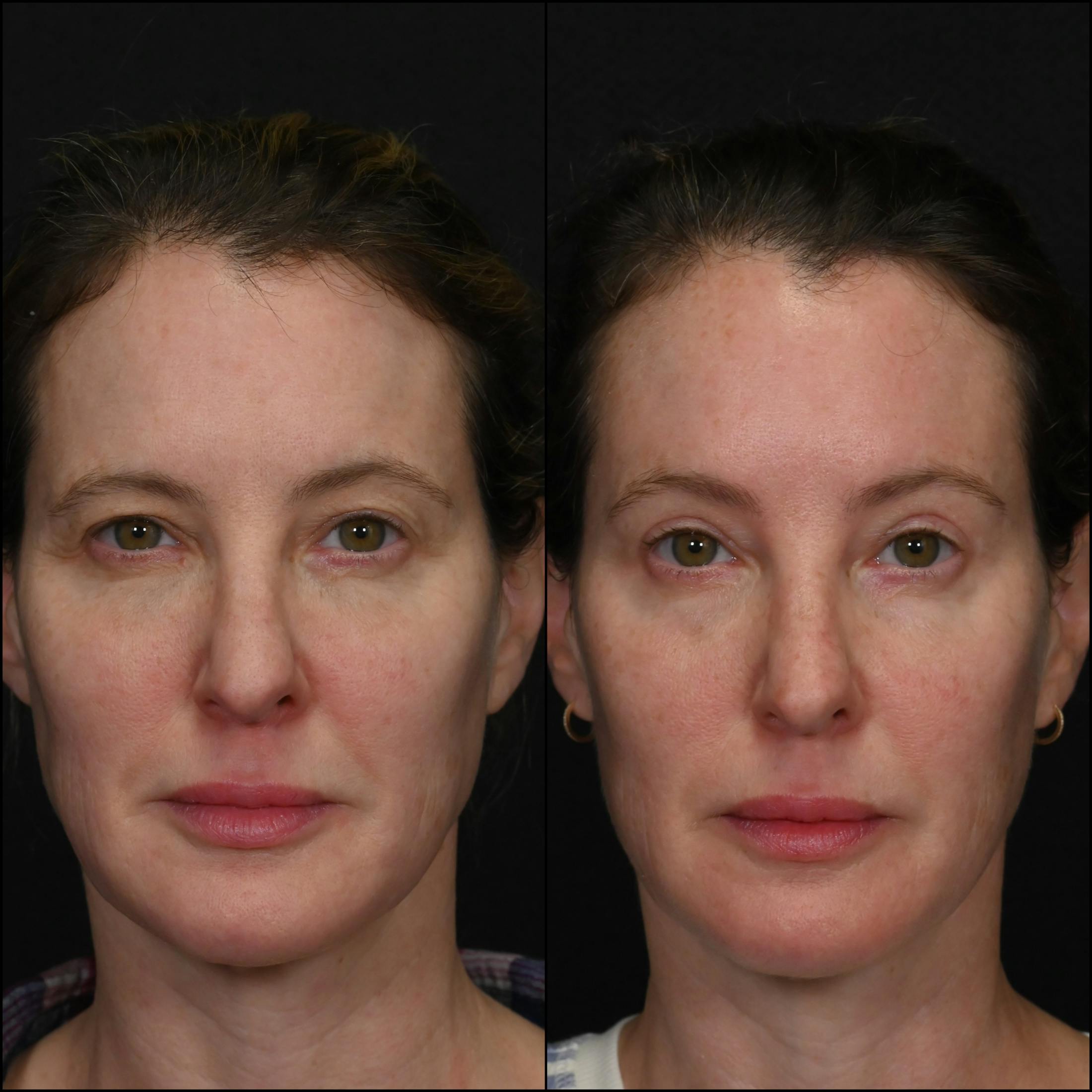 Brow Lift Before & After Gallery - Patient 106055 - Image 1