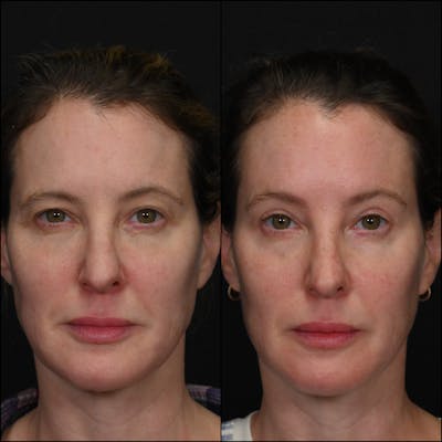 Upper Blepharoplasty Before & After Gallery - Patient 231717 - Image 1