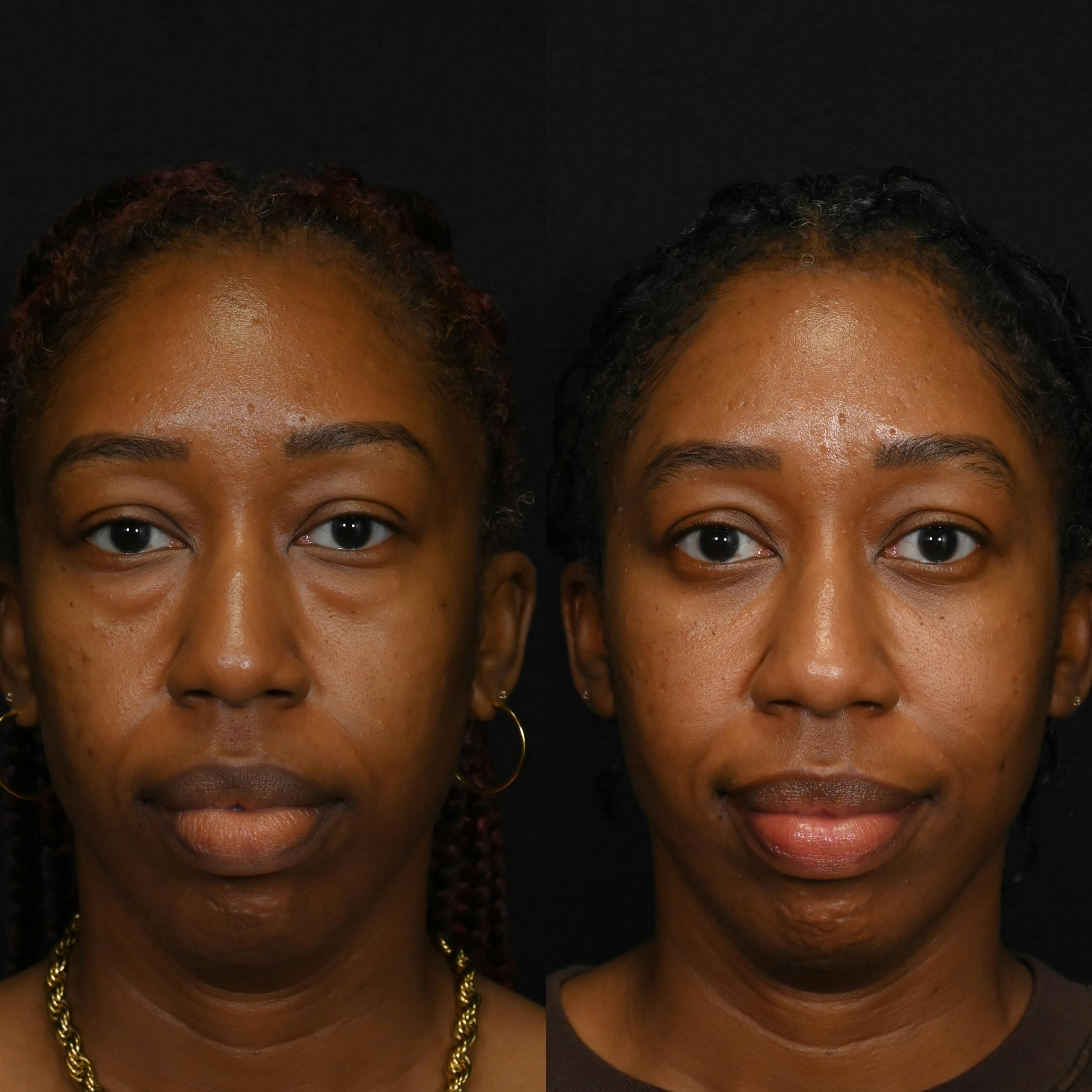 Lower Blepharoplasty Before & After Gallery - Patient 242078 - Image 1