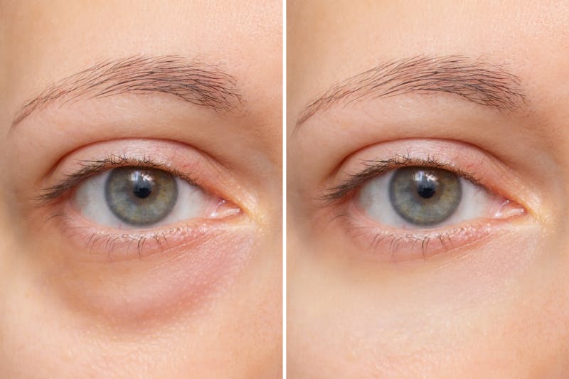 under eye bag graphic