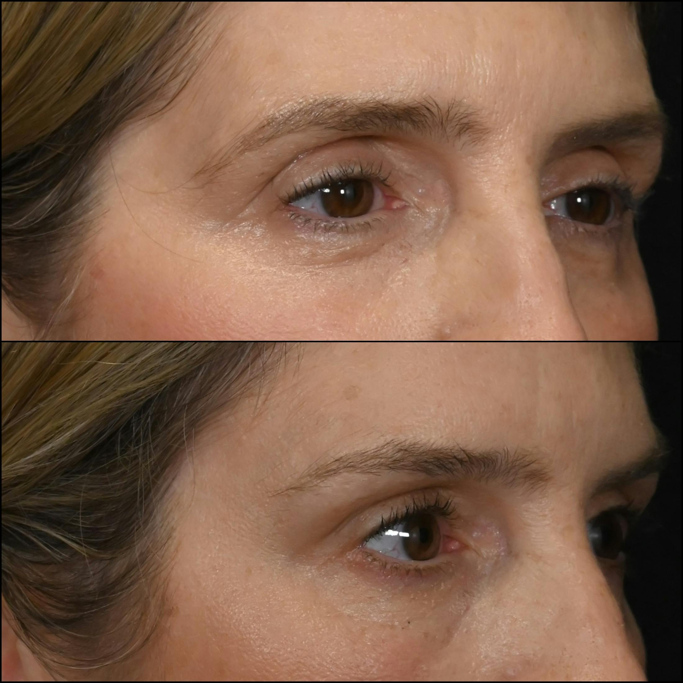 Brow Lift Before & After Gallery - Patient 949810 - Image 3