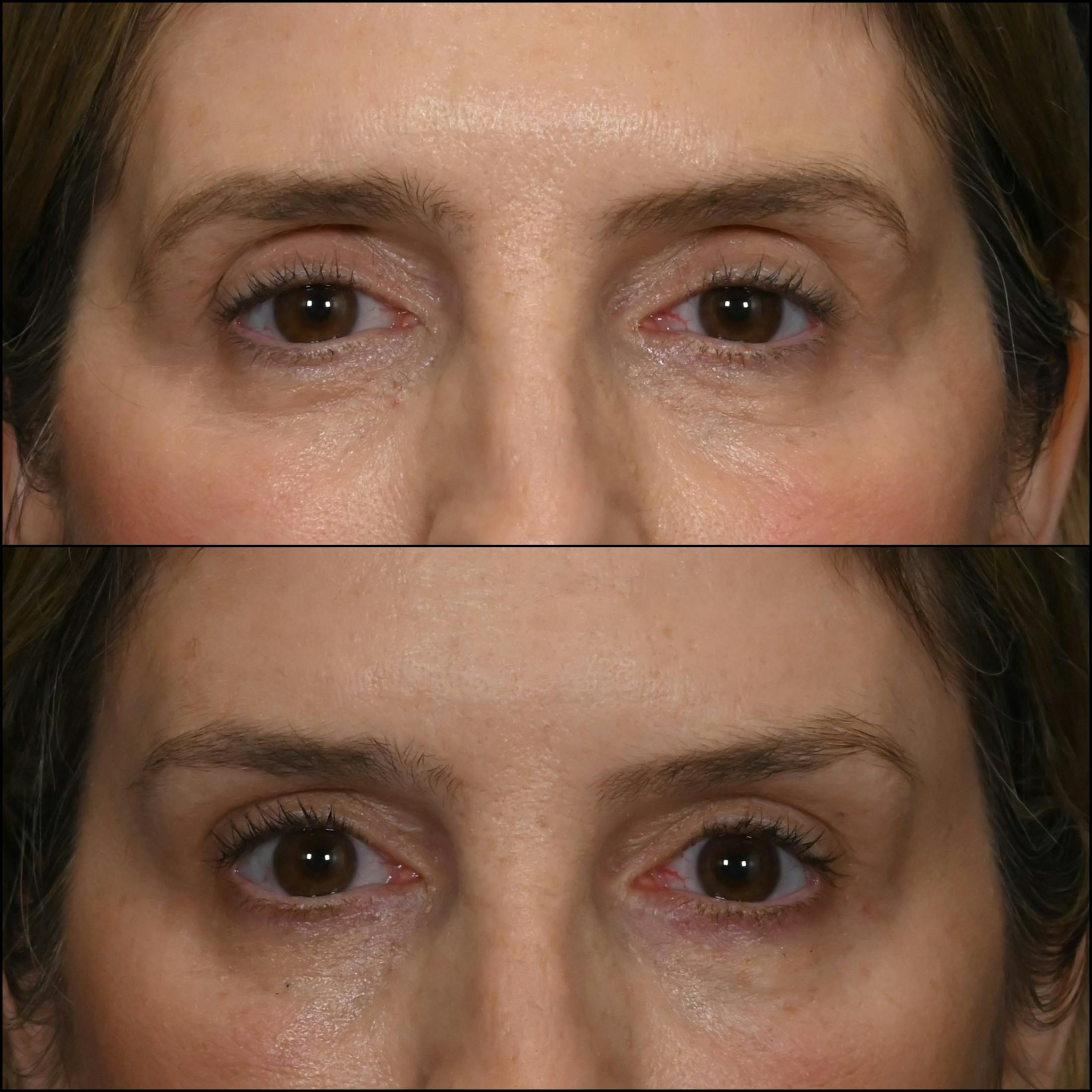 Brow Lift Before & After Gallery - Patient 949810 - Image 1