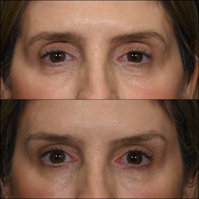 Lower Blepharoplasty Before & After Gallery - Patient 105550 - Image 1
