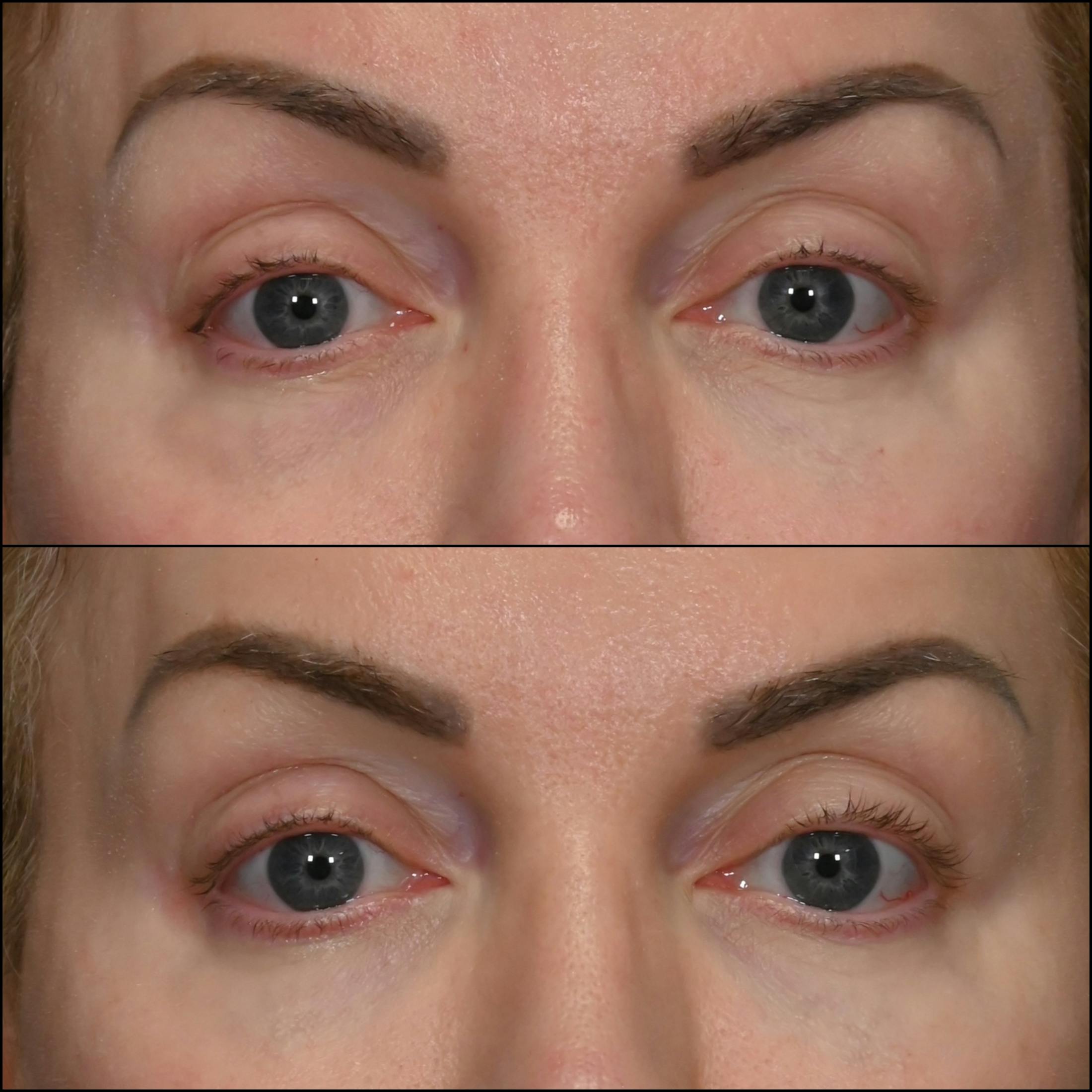 Revision Surgery Before & After Gallery - Patient 306830 - Image 1