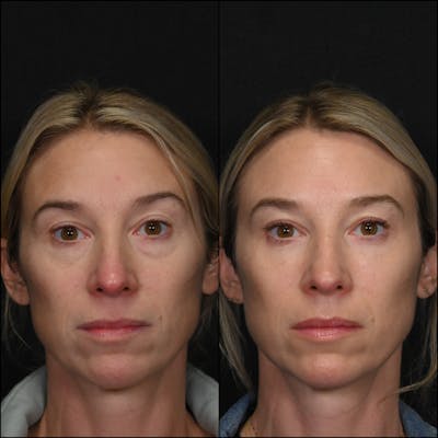 Lower Blepharoplasty Before & After Gallery - Patient 105550 - Image 1