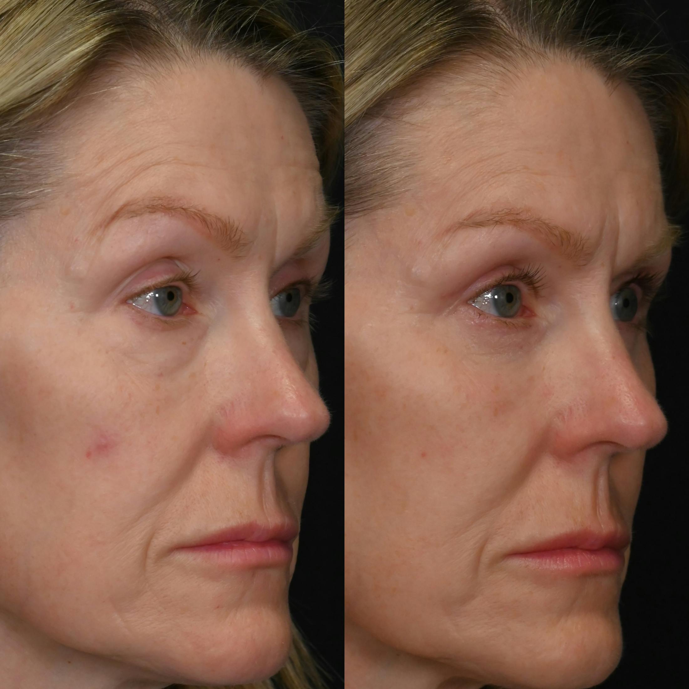 Upper & Lower Blepharoplasty Before & After Gallery - Patient 137775 - Image 2