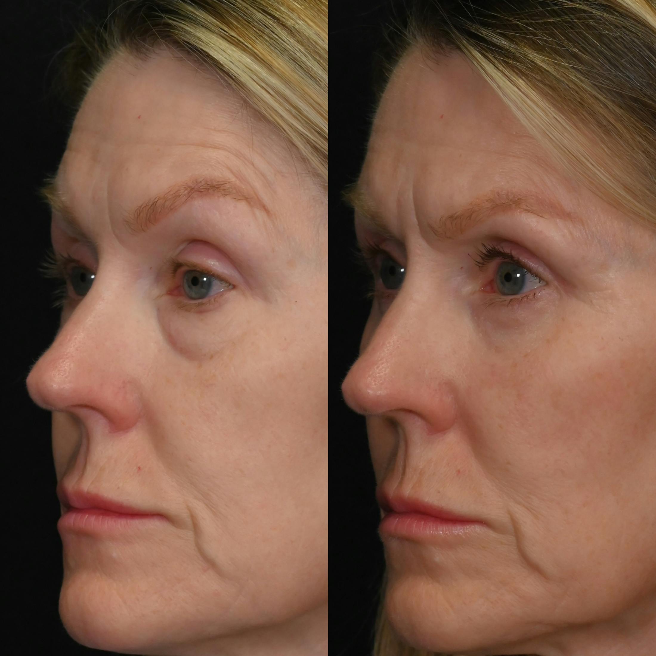 Upper & Lower Blepharoplasty Before & After Gallery - Patient 137775 - Image 3
