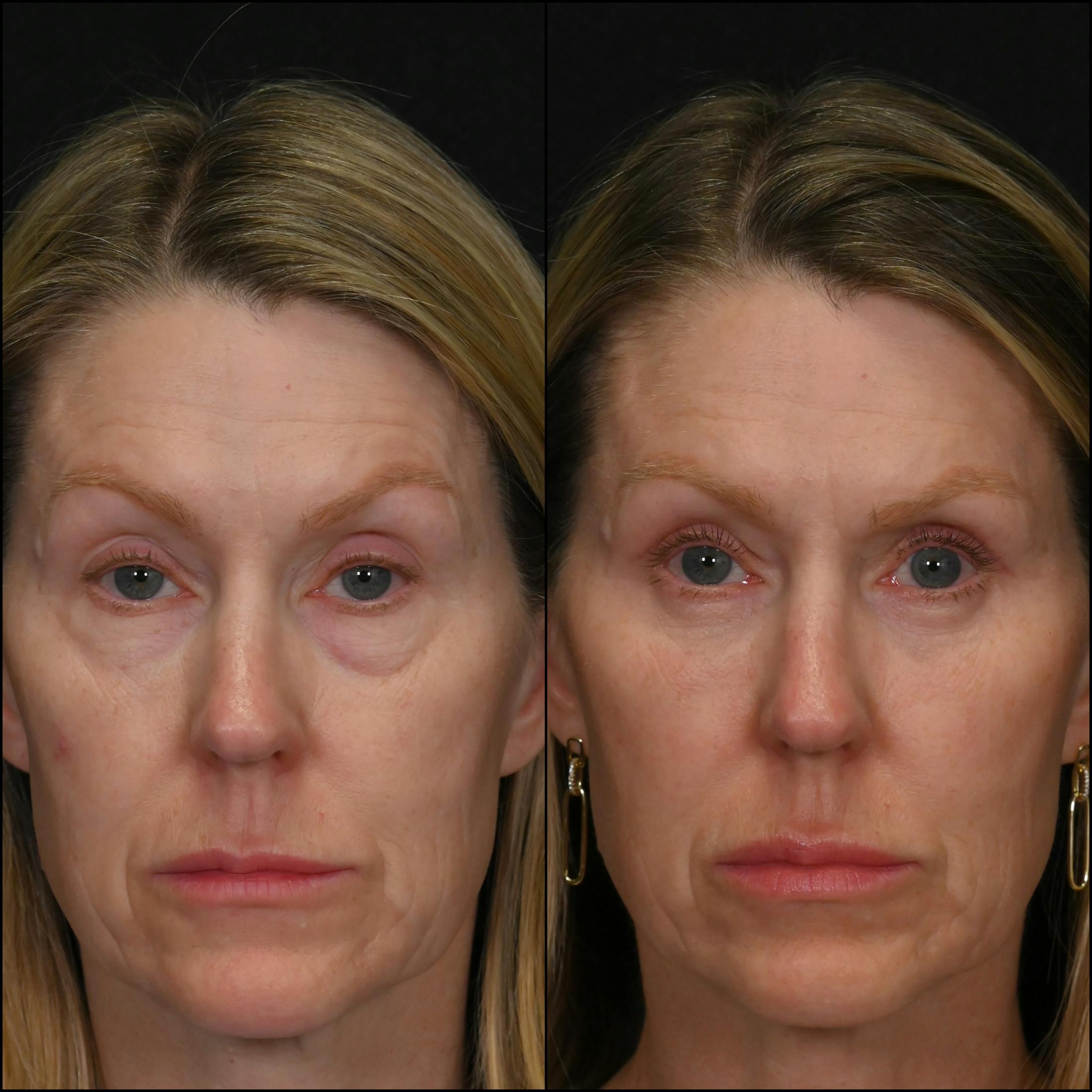 Upper & Lower Blepharoplasty Before & After Gallery - Patient 137775 - Image 1
