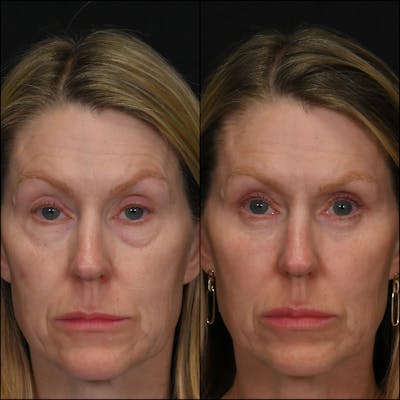 Upper Blepharoplasty Before & After Gallery - Patient 420605 - Image 1