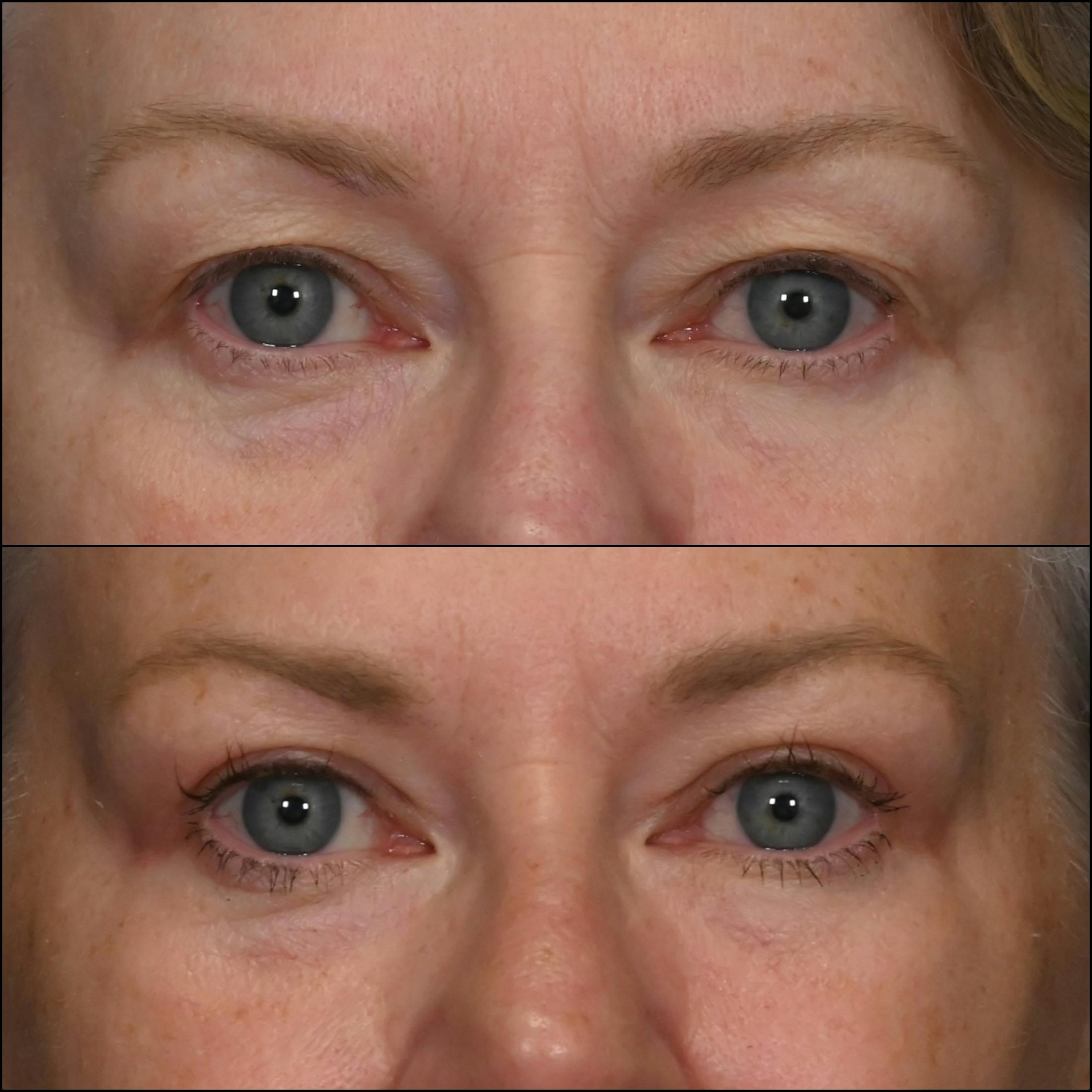 Upper Blepharoplasty Before & After Gallery - Patient 223328 - Image 1
