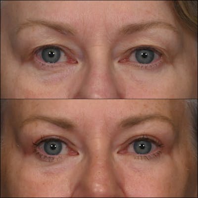 Upper Blepharoplasty Before & After Gallery - Patient 223328 - Image 1