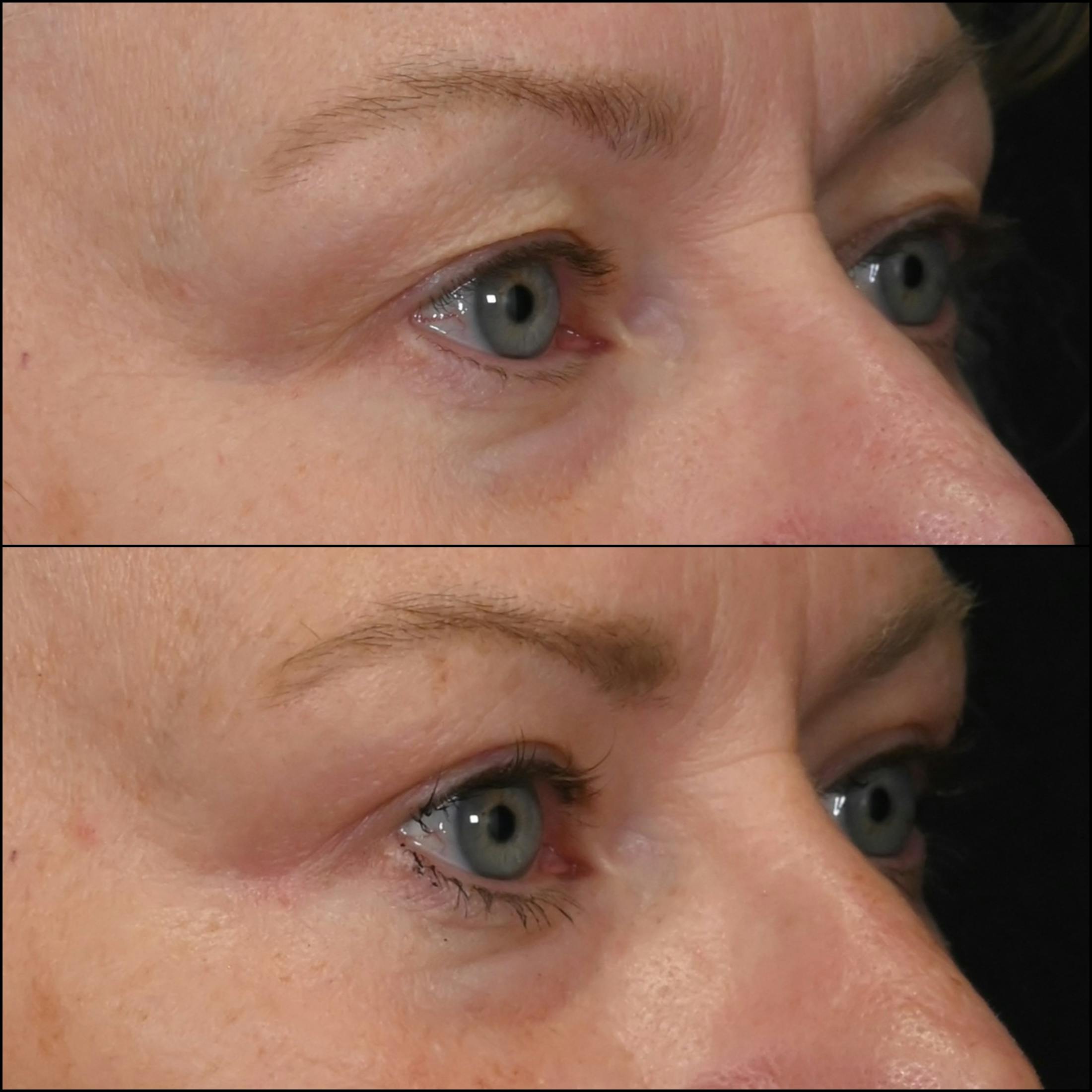 Upper Blepharoplasty Before & After Gallery - Patient 223328 - Image 3