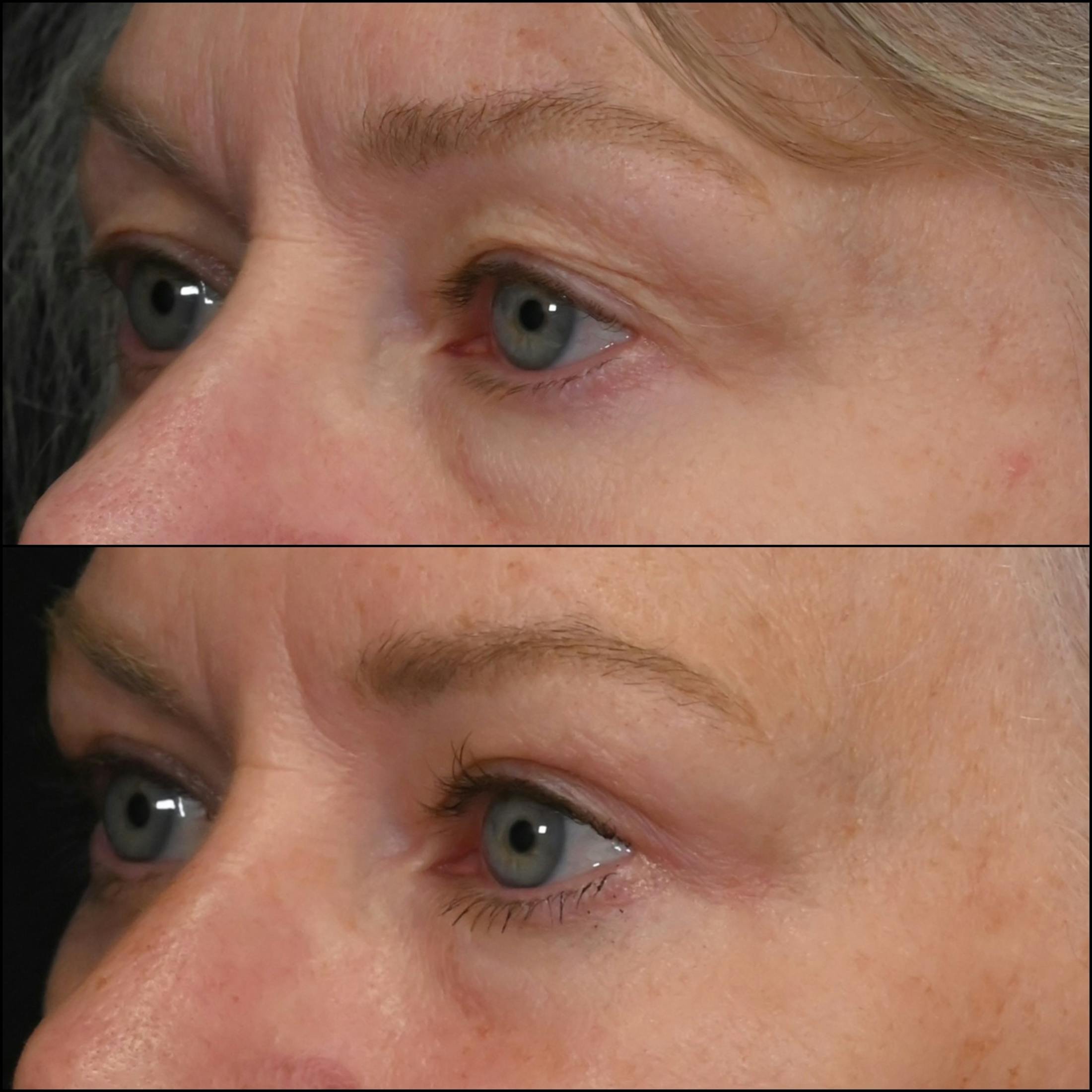 Upper Blepharoplasty Before & After Gallery - Patient 223328 - Image 2