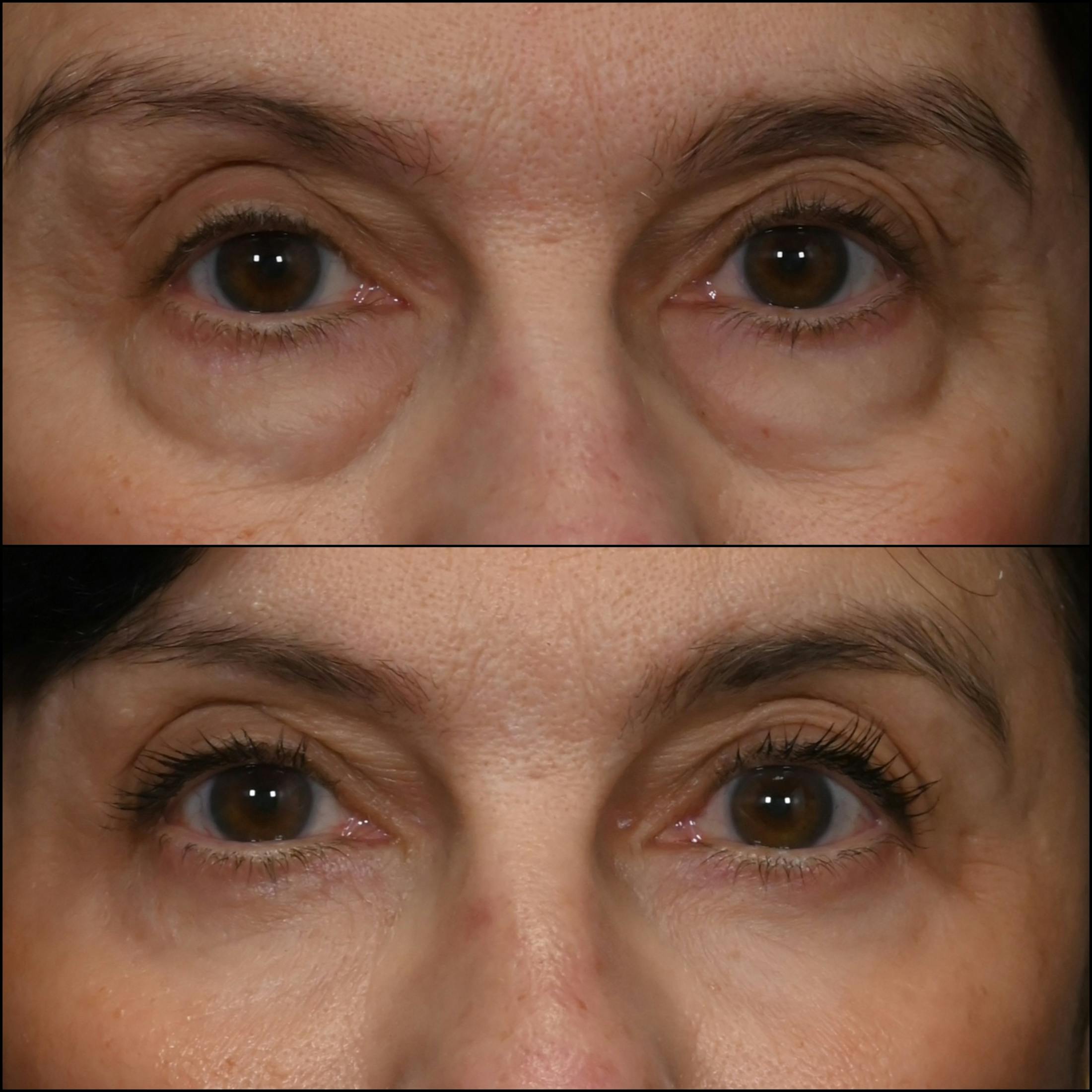 Lower Blepharoplasty Before & After Gallery - Patient 131573 - Image 1