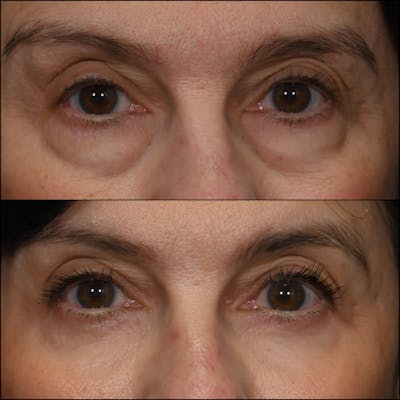 Lower Blepharoplasty Before & After Gallery - Patient 131573 - Image 1