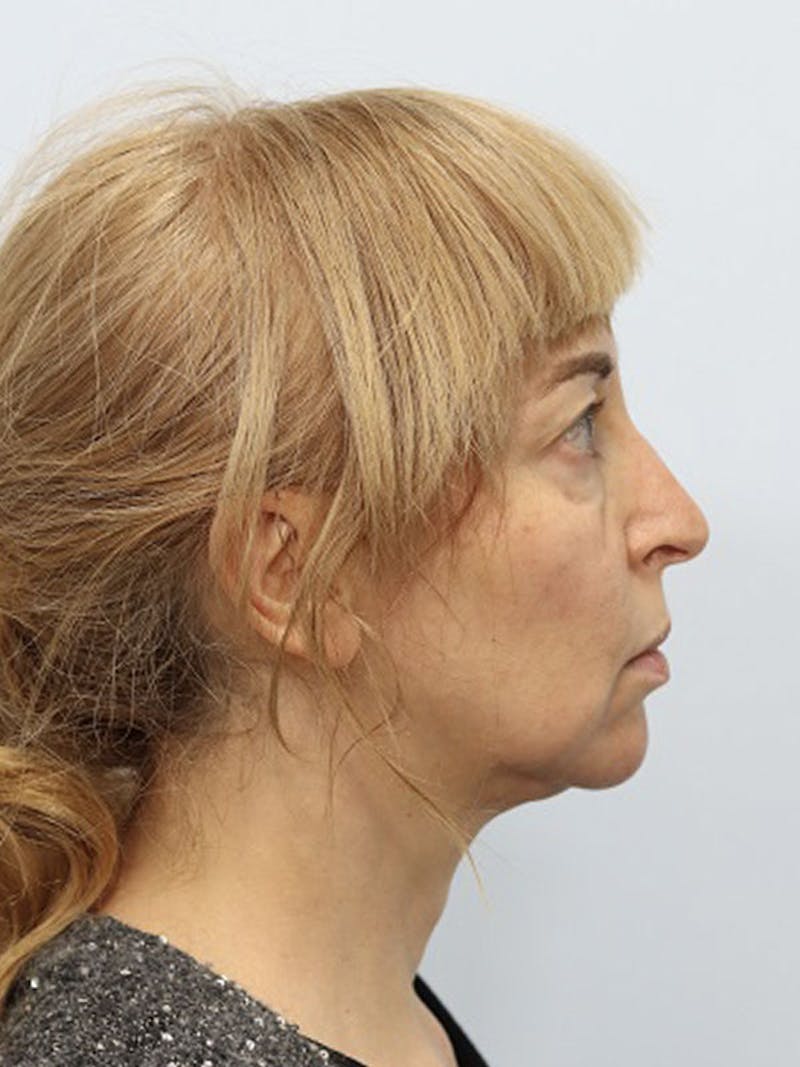 Laser Skin Treatment Before & After Gallery - Patient 121841171 - Image 4