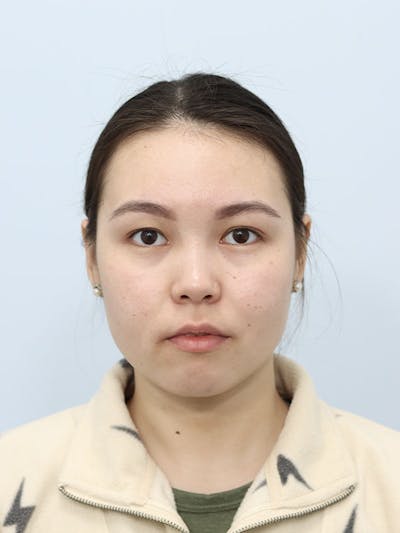 Buccal Fat Removal Before & After Gallery - Patient 121841155 - Image 1