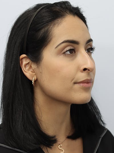 Non-Surgical Rhinoplasty Gallery - Patient 121953695 - Image 1