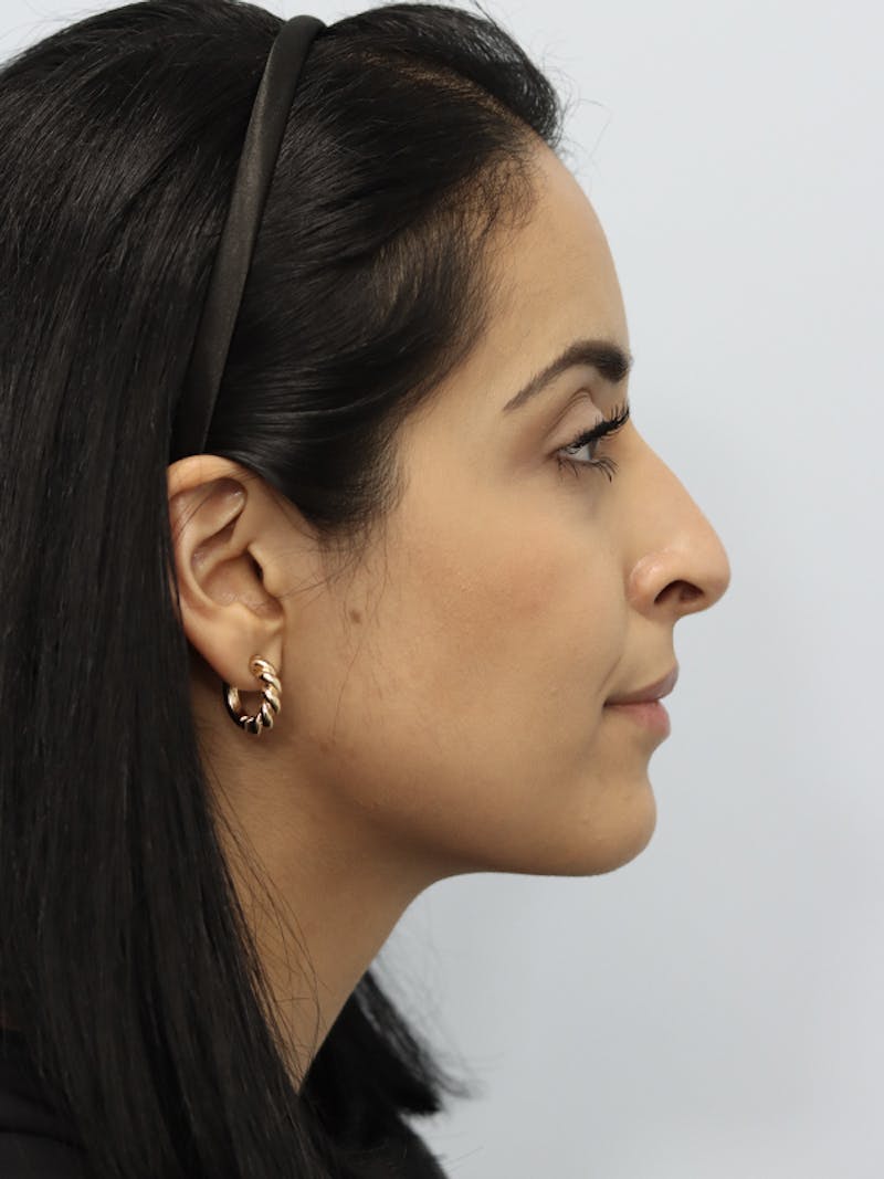 Non-Surgical Rhinoplasty Before & After Gallery - Patient 121953695 - Image 3