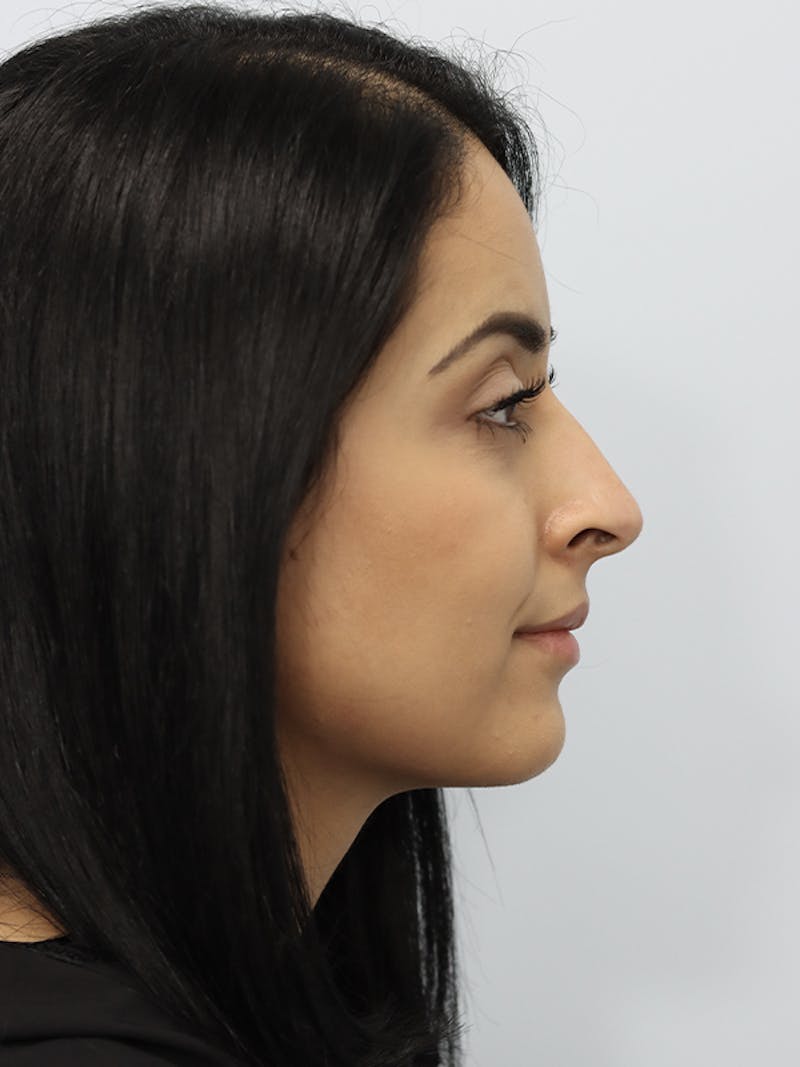 Non-Surgical Rhinoplasty Before & After Gallery - Patient 121953695 - Image 4