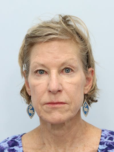 Facelift Before & After Gallery - Patient 123841168 - Image 1