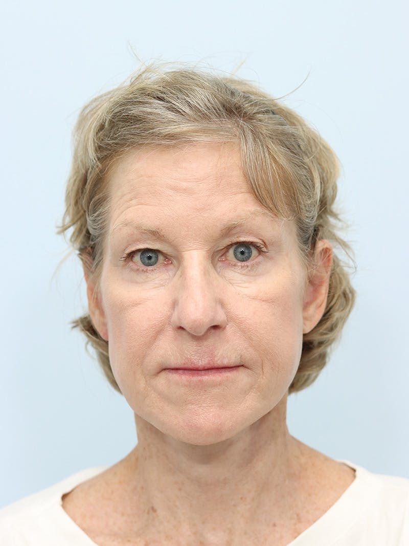 Facelift Before & After Gallery - Patient 123841168 - Image 2