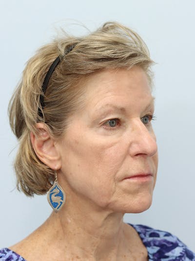 Neck Lift Before & After Gallery - Patient 123841172 - Image 1