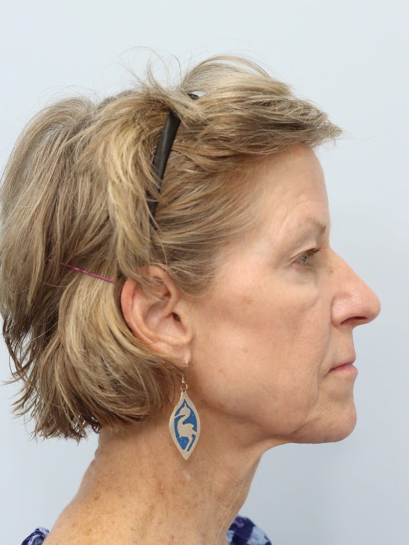 Facelift Before & After Gallery - Patient 123841168 - Image 5