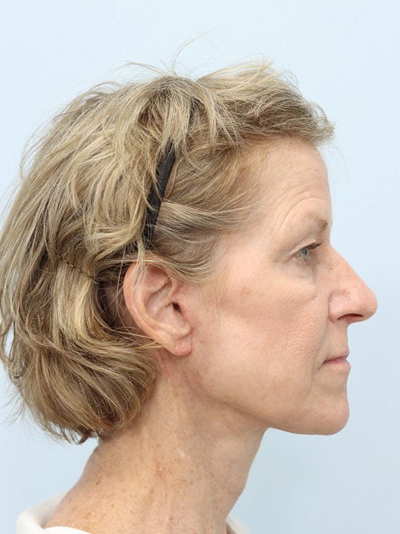 Facelift Before & After Gallery - Patient 123841168 - Image 6